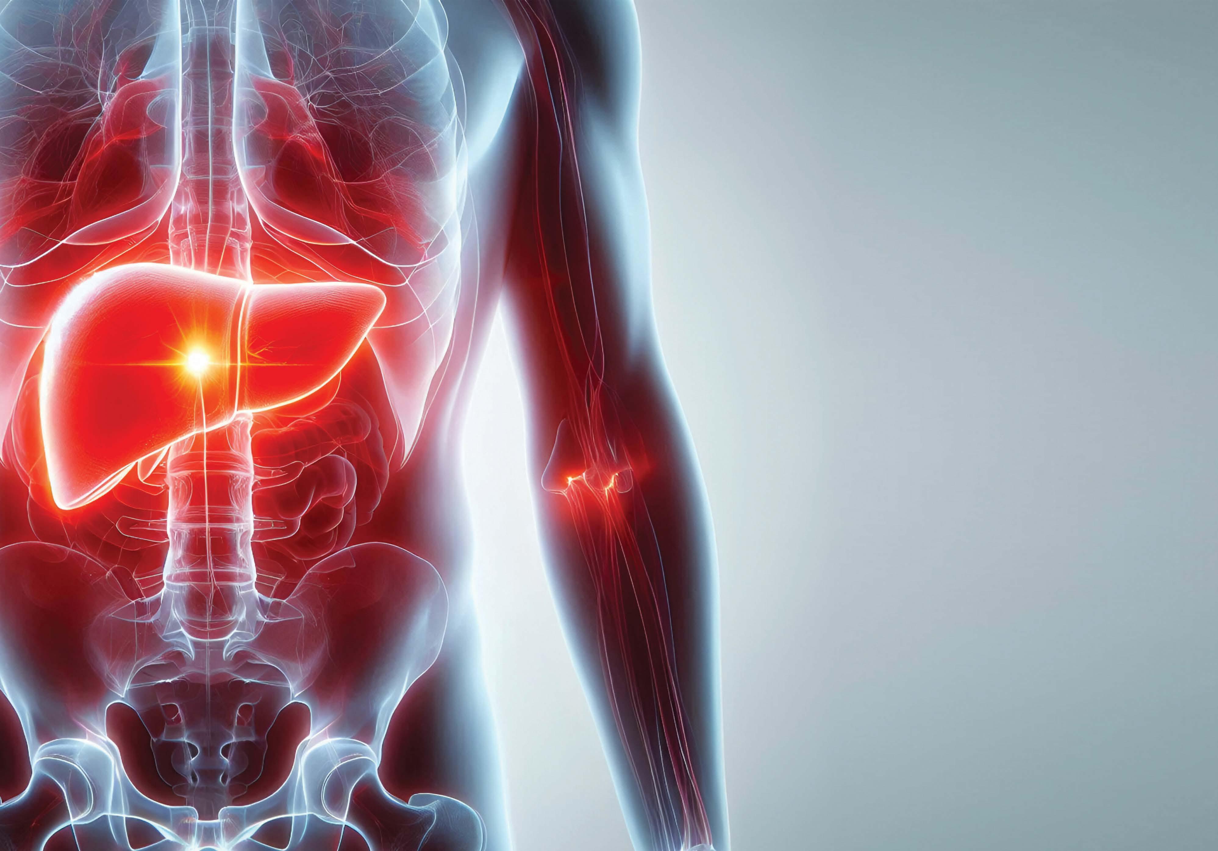 LIVER DISEASE: THE HIDDEN DANGER